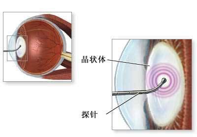 白内障手术