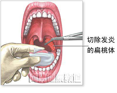 扁桃体切除术