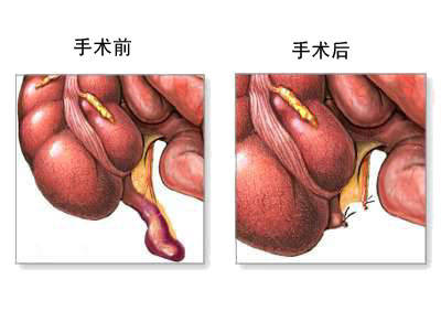 阑尾切除术
