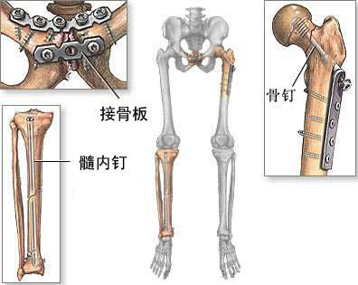 骨折修复术
