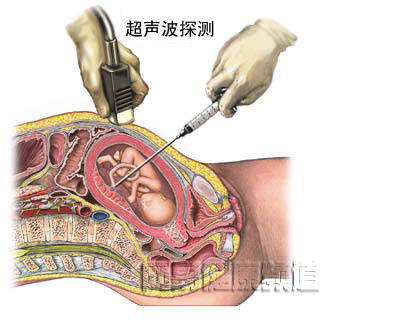 胎儿脐血取样