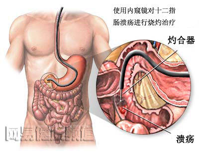 消化道出血治疗